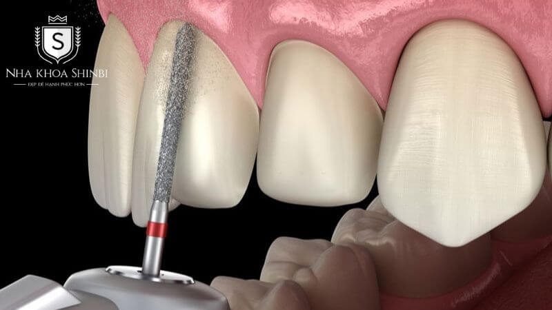 Có nên bọc răng sứ Zirconia? Có nên bọc răng sứ Zirconia?