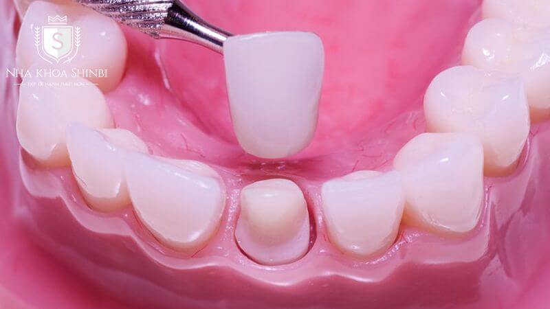 Bọc răng sứ Zirconia có độ bền cao
