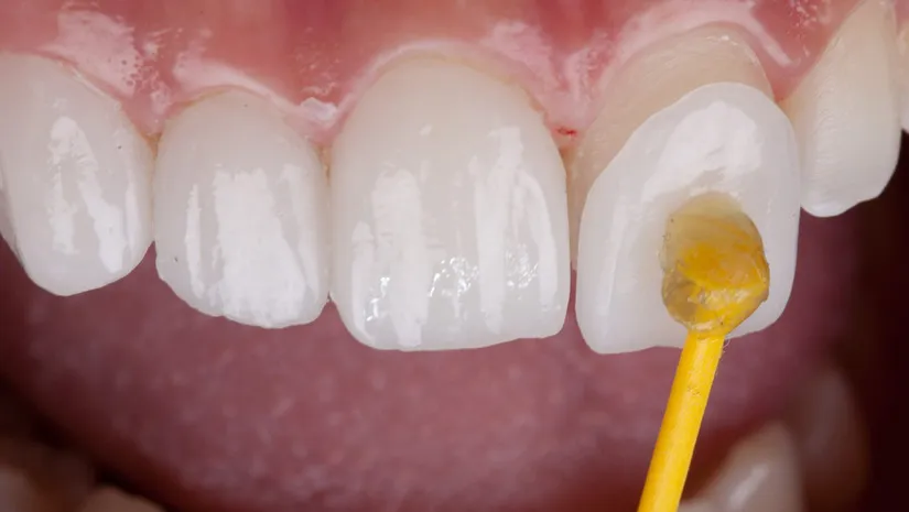 Có nên dán sứ Veneer răng cửa không? Giải đáp mọi thắc mắc