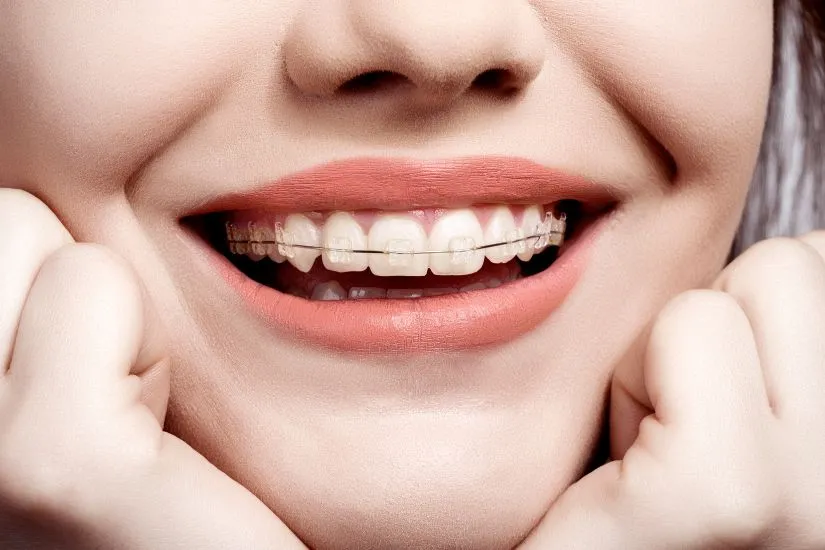 Giá niềng răng sứ thẩm mỹ tại Hà Nội Giá niềng răng sứ thẩm mỹ tại Hà Nội