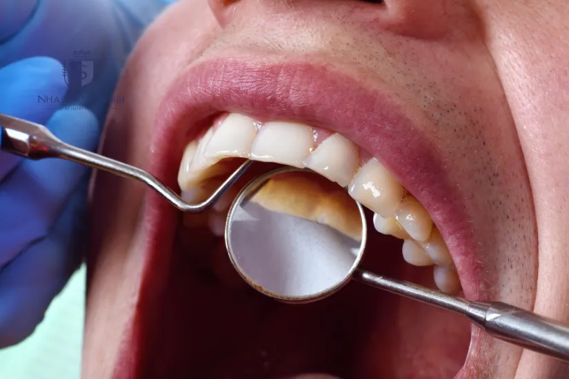Ít gây cảm giác ê buốt, đau, nhạy cảm cho răng