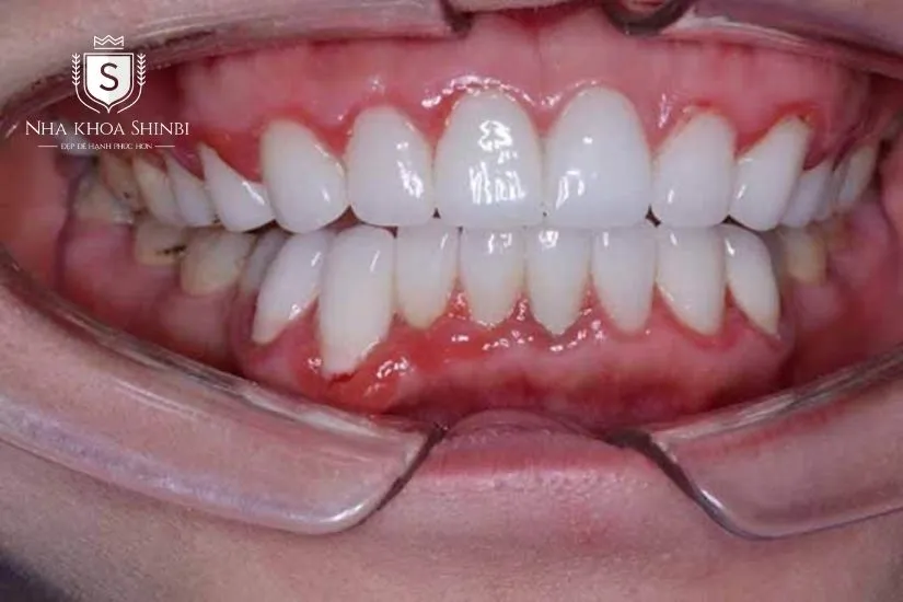 Bọc sứ làm gây ra bệnh lý răng miệng Bọc sứ làm gây ra bệnh lý răng miệng