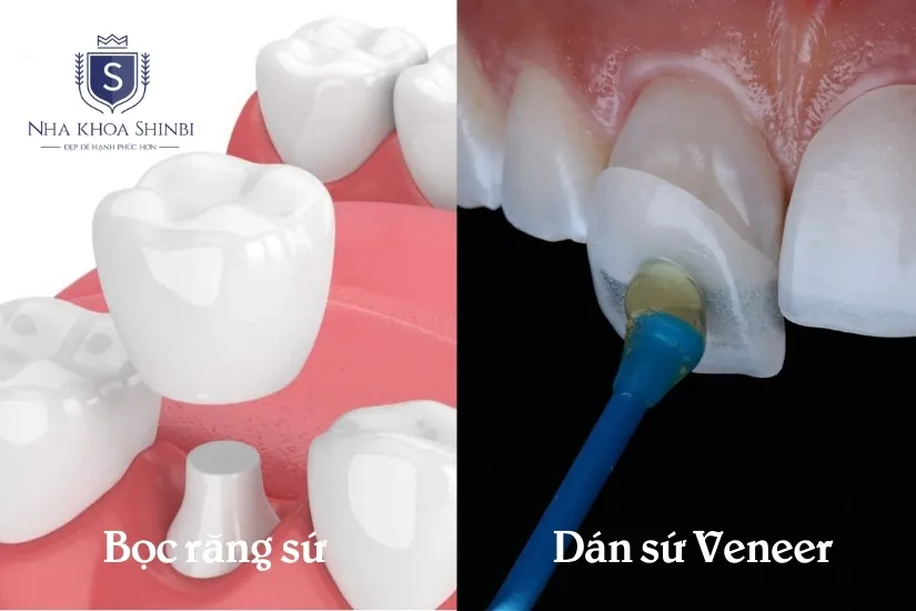 Những kỹ thuật răng sứ đang phổ biến