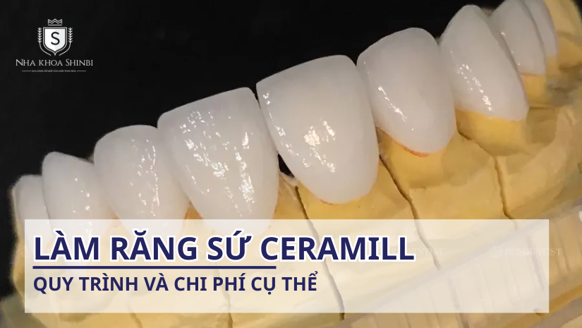 Làm răng sứ Ceramill khi nào? Quy trình và chi phí cụ thể