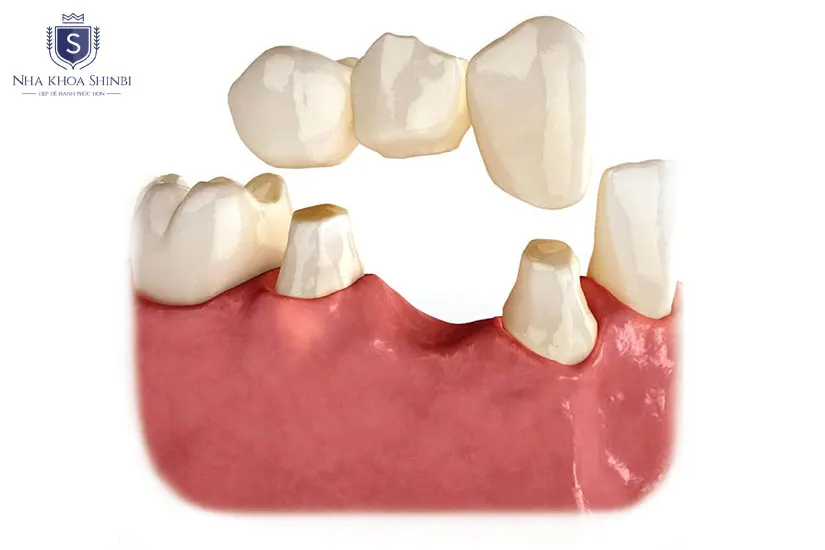 Làm răng sứ giả với cầu răng sứ