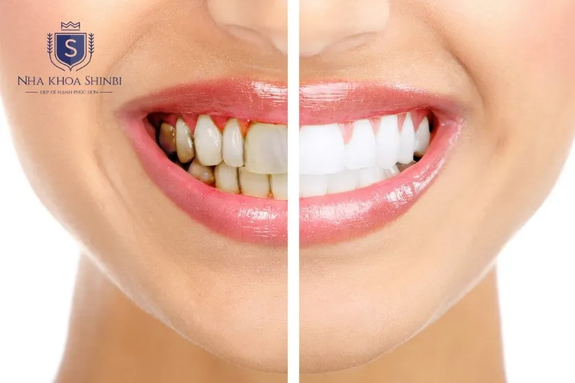 Lưu ý khi chọn bọc răng sứ của Đức Lưu ý khi chọn bọc răng sứ của Đức