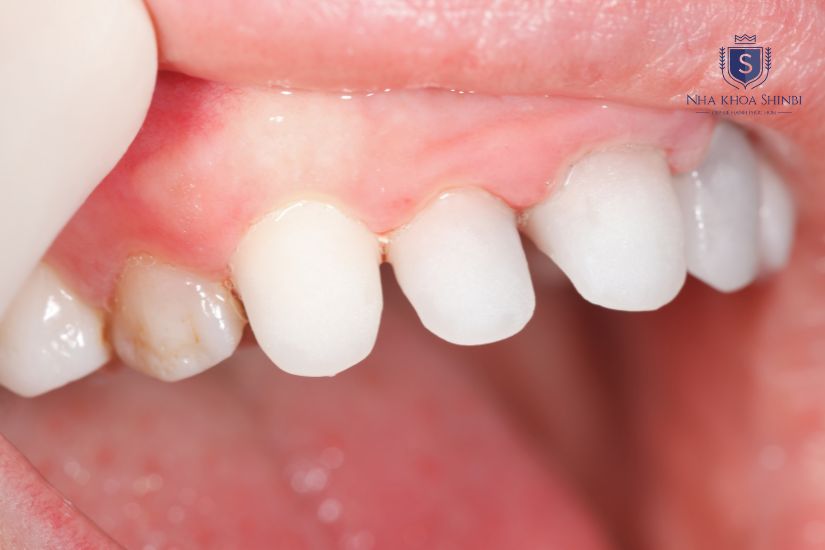 Quá trình bọc răng sứ 
