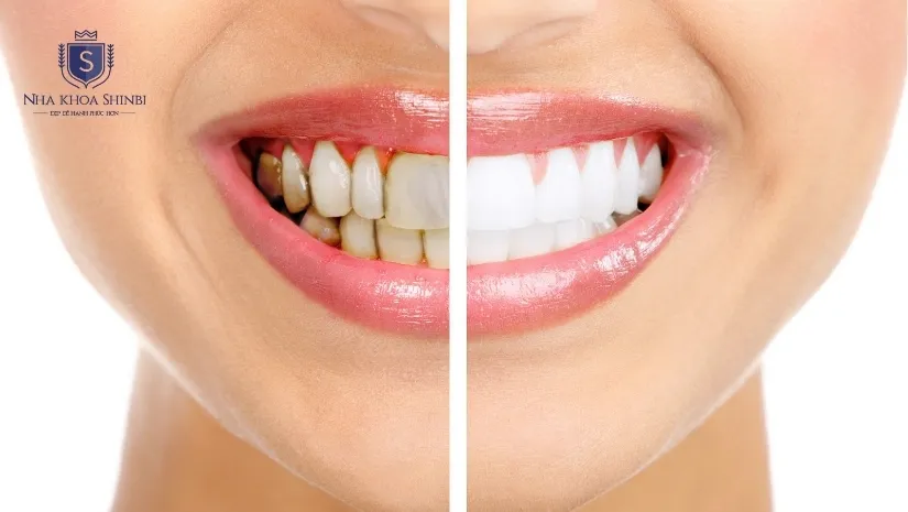 Miếng dán răng sứ Veneer là gì? Tất tần tật về dán răng sứ