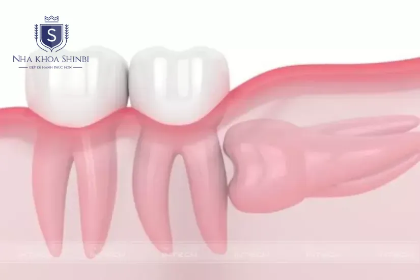 Mức độ phức tạp của răng khôn