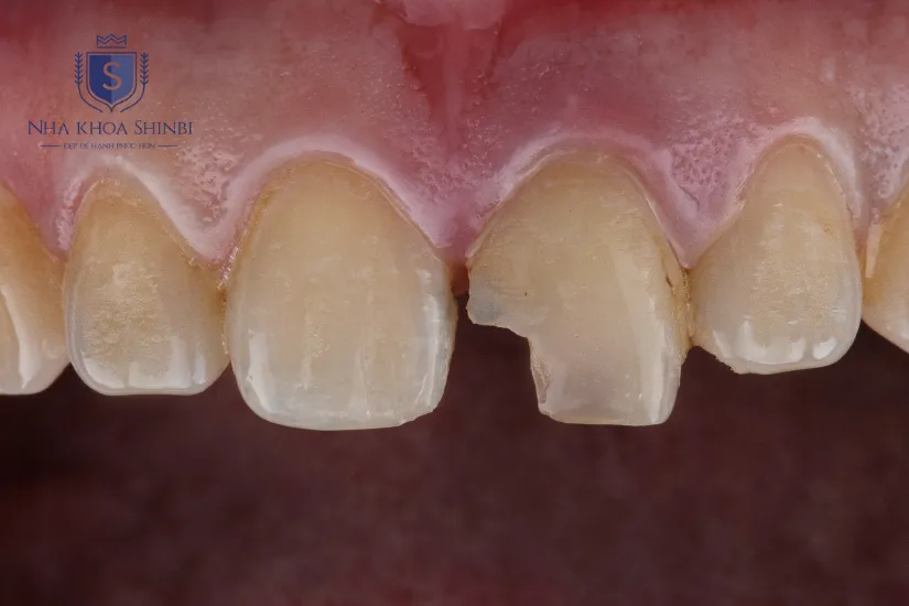 Những ai có thể bọc răng sứ Titan Những ai có thể bọc răng sứ Titan