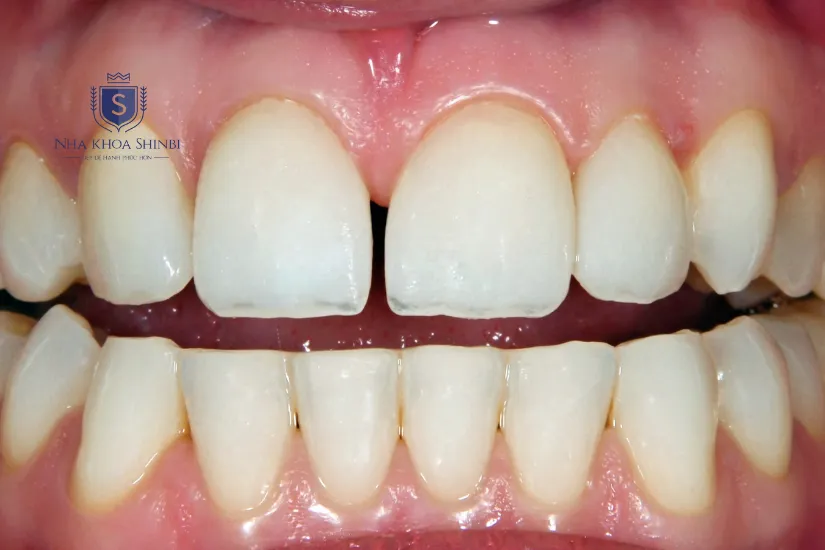 Những ai nên dán sứ Veneer Ultrathin?
