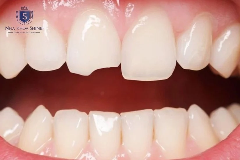 Những trường hợp cần bọc răng sứ 
