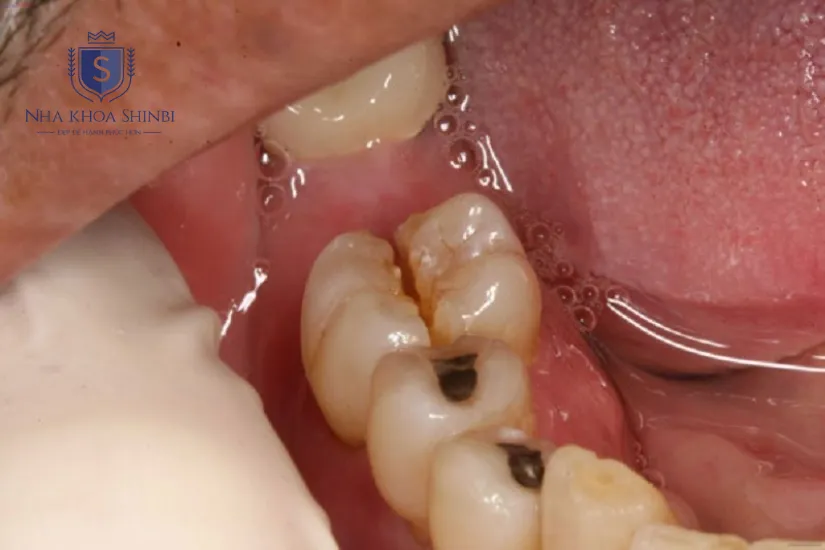 Những trường hợp nào cần phải bọc răng sứ số 6 Những trường hợp nào cần phải bọc răng sứ số 6