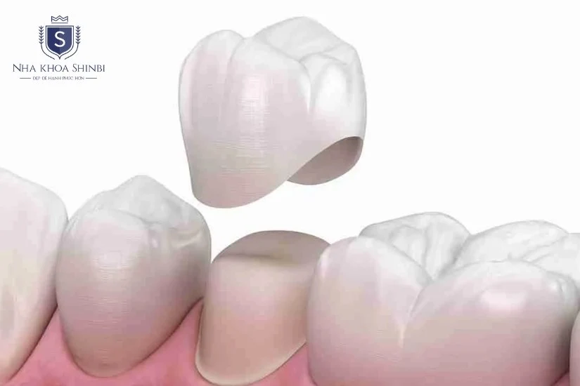 Phục hồi chức năng ăn nhai gần giống răng thật