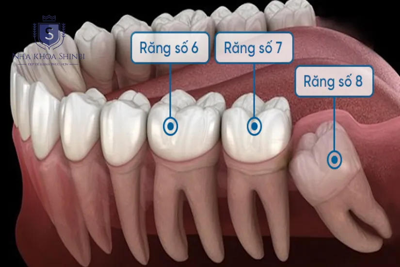 Quy trình 5 bước bọc răng sứ số 6 Quy trình 5 bước bọc răng sứ số 6