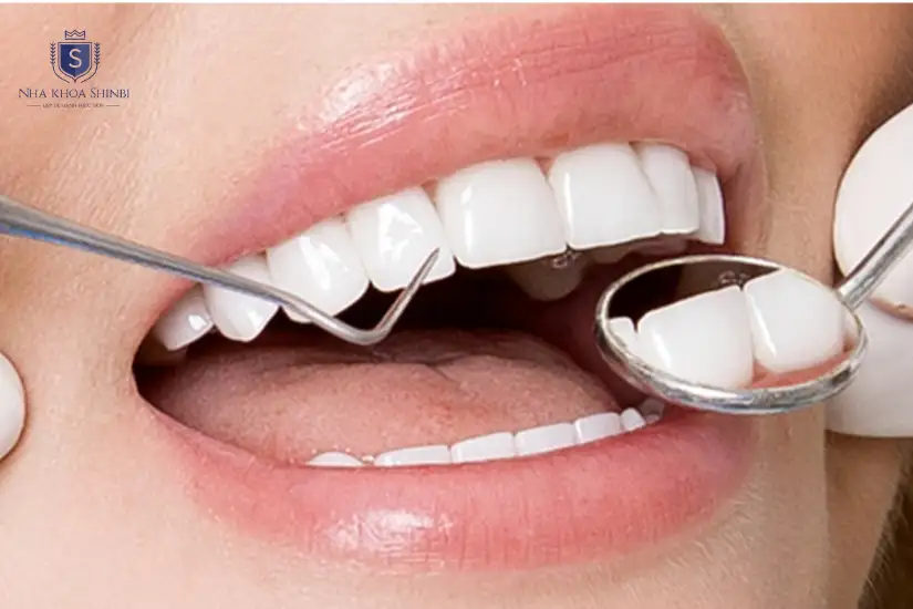 Quy trình bọc răng sứ Titan đúng chuẩn 1 Quy trình bọc răng sứ Titan đúng chuẩn 1