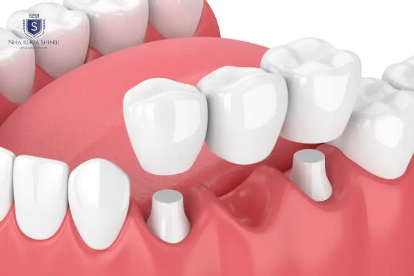 Quy trình bọc răng sứ Titan đúng chuẩn 2 Quy trình bọc răng sứ Titan đúng chuẩn 2