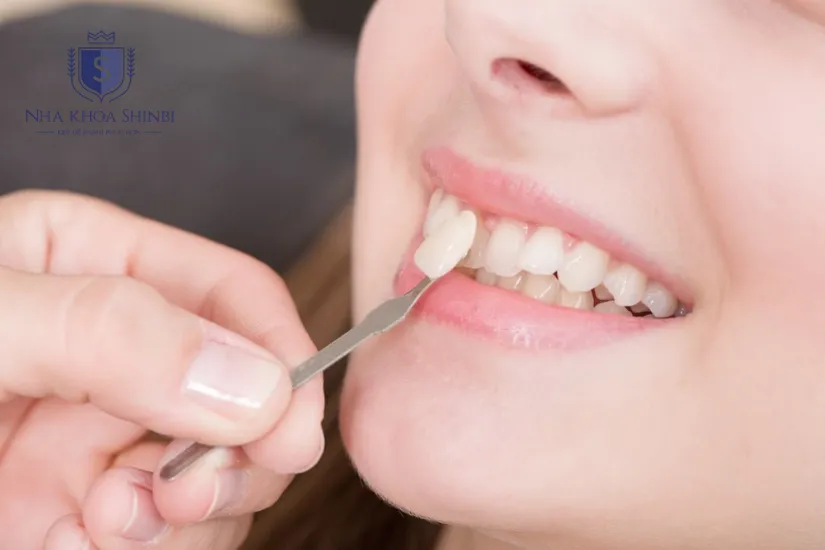Quy trình dán sứ veneer đúng chuẩn y khoa