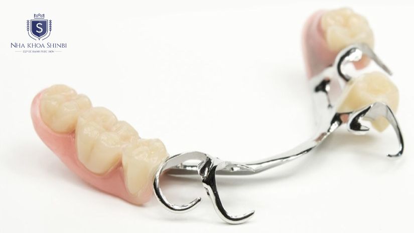 Răng sứ tháo lắp khung kim loại Răng sứ tháo lắp khung kim loại