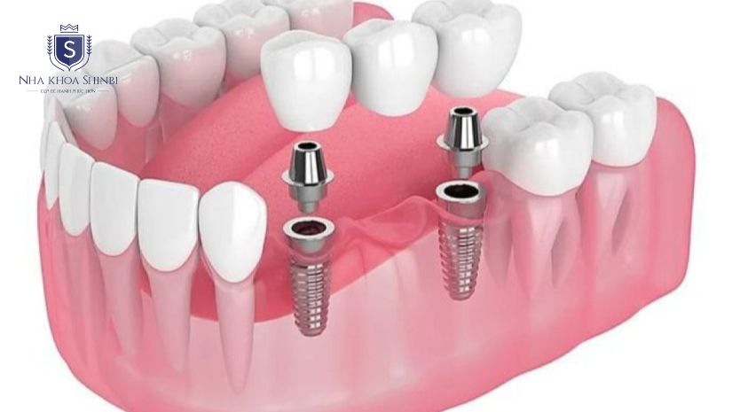 Răng sứ tháo lắp trên implant Răng sứ tháo lắp trên implant