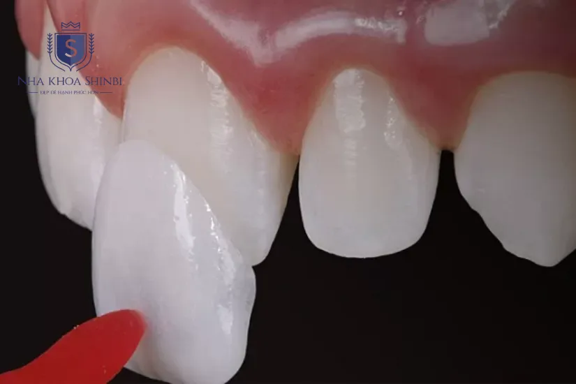 Thử veneer lên răng và điều chỉnh