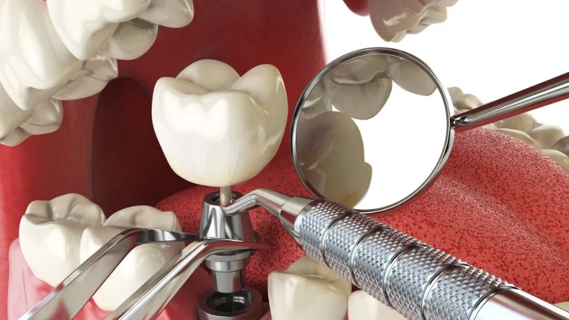 Trồng răng implant loại nào tốt? Tiêu chí đánh giá implant