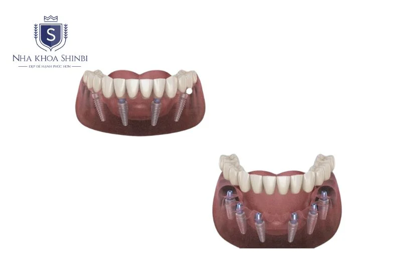 Trồng răng implant nguyên hàm loại nào tốt nhất?