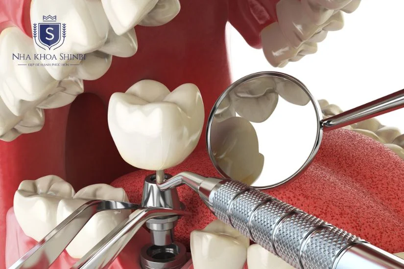 Quy trình trồng răng implant nguyên hàm 