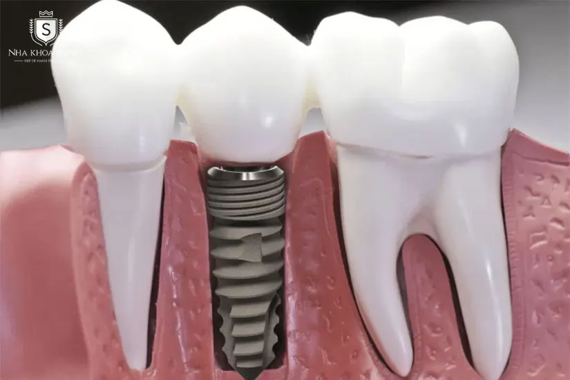 Trồng răng Implant với mão răng sứ