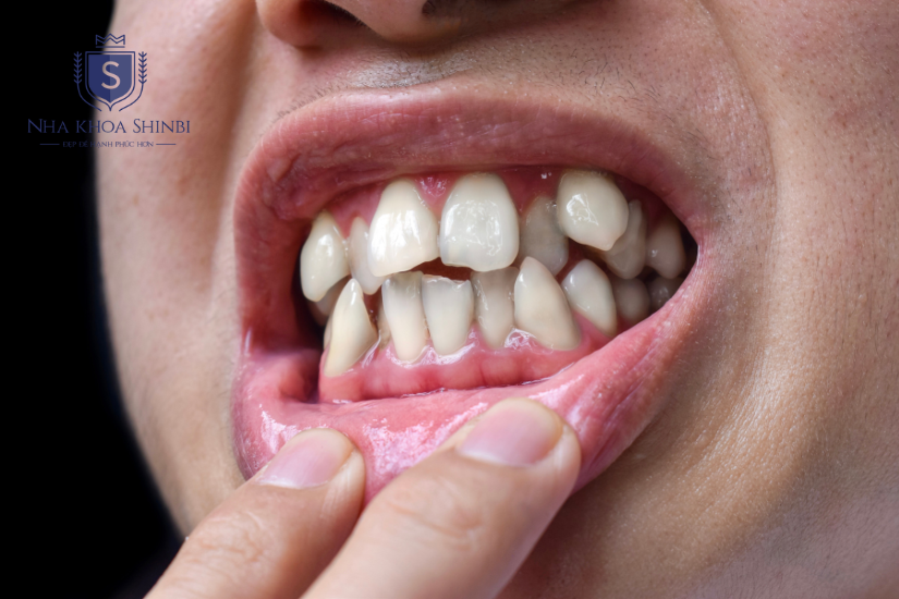 Trường hợp nào cần làm răng nanh sứ? Trường hợp nào cần làm răng nanh sứ?