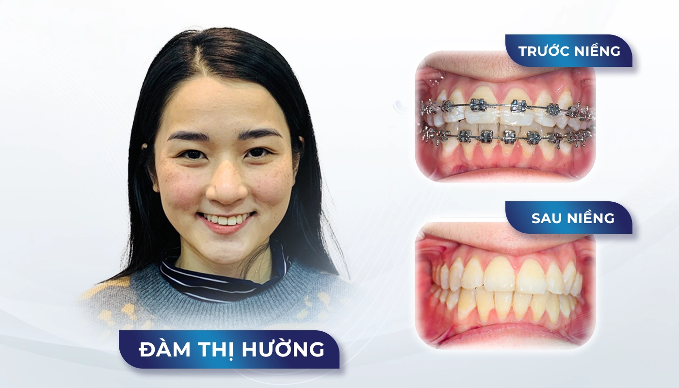 Niềng mắc cài kim loại tiết kiệm độ khó 1