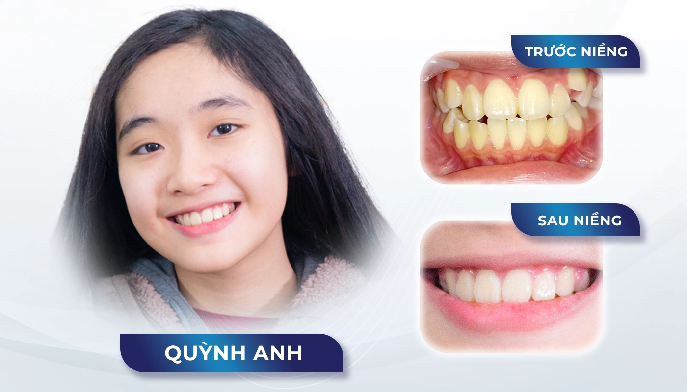 Niềng trong suốt Invisalign Lite hai hàm • Nha khoa Shinbi