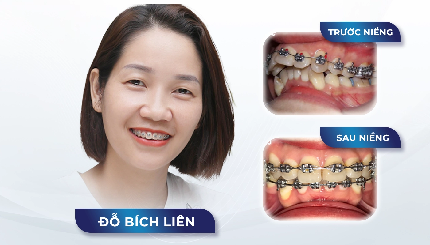 Niềng mắc cài kim loại tiết kiệm độ khó 2