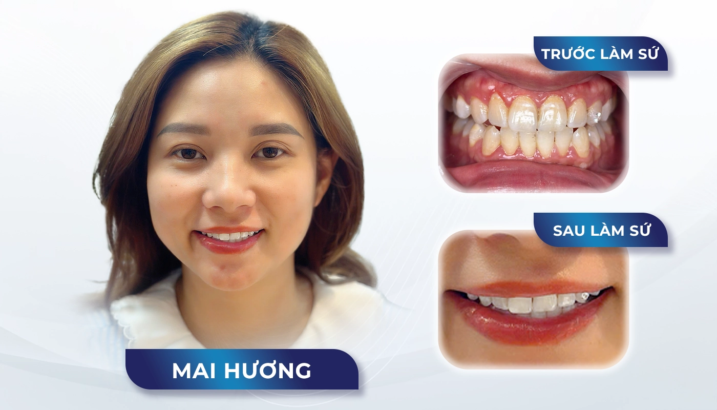 Dán sứ 3D Promax