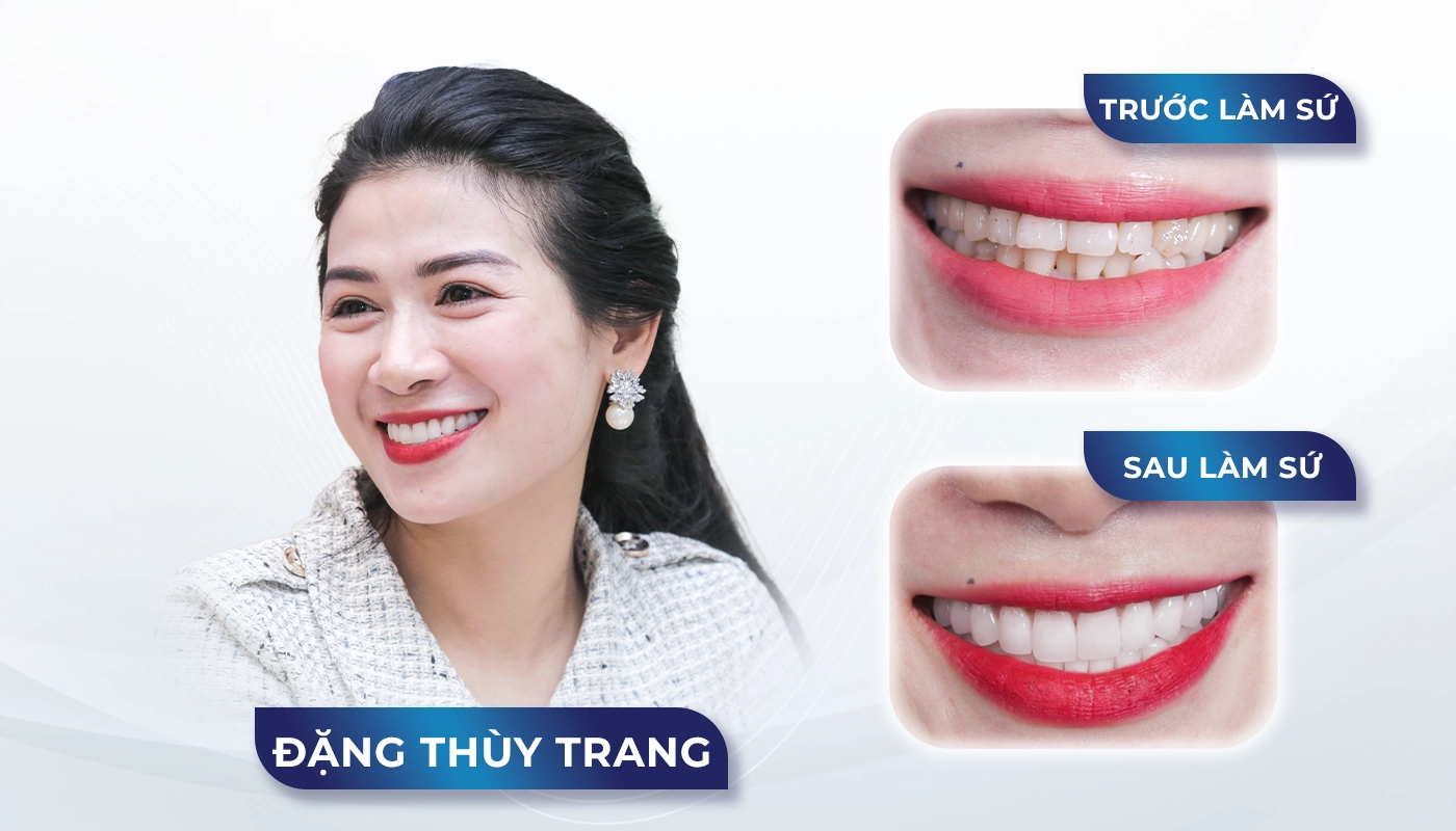 Răng sứ lõi Titan