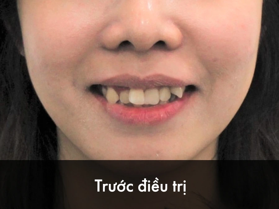 Nguyễn Lương Hà (24 tuổi) - Trước điều trị