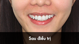 Nguyễn Lương Hà (24 tuổi) - Sau điều trị