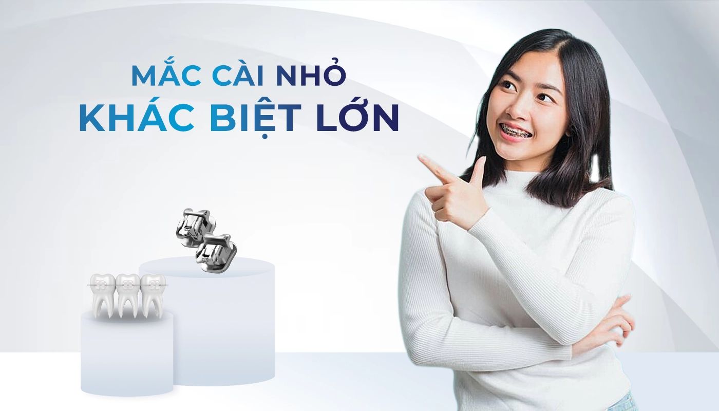 Niềng mắc cài kim loại tiết kiệm độ khó 2