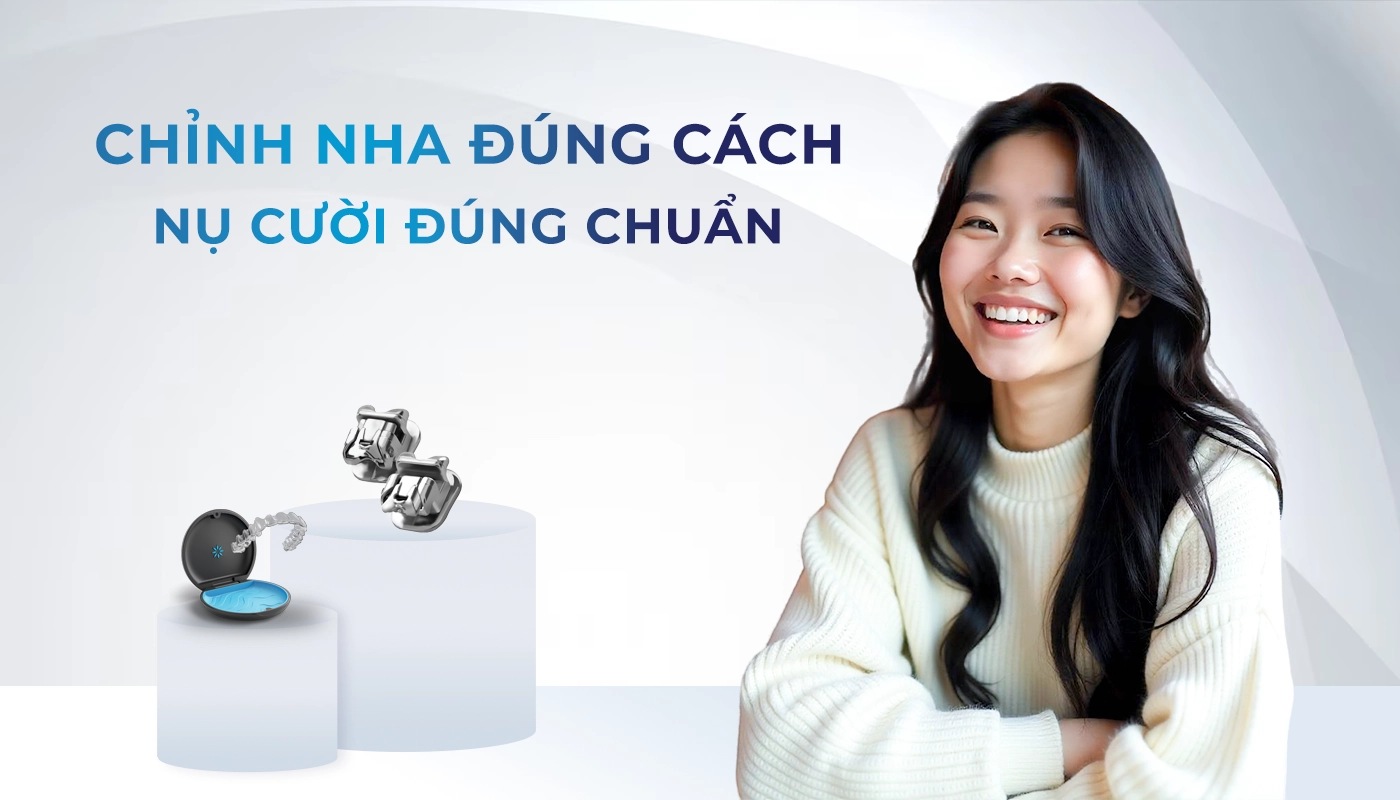 Niềng mắc cài kim loại tiết kiệm độ khó 1