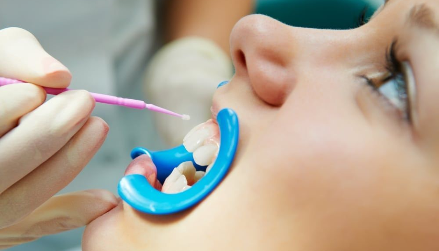 Trám Sealant ngừa sâu trẻ em