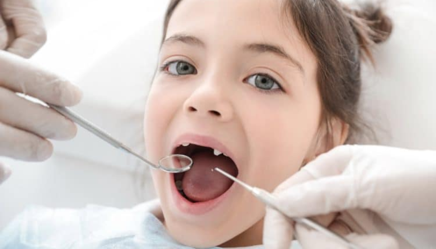 Chụp mão kim loại có sẵn răng sữa