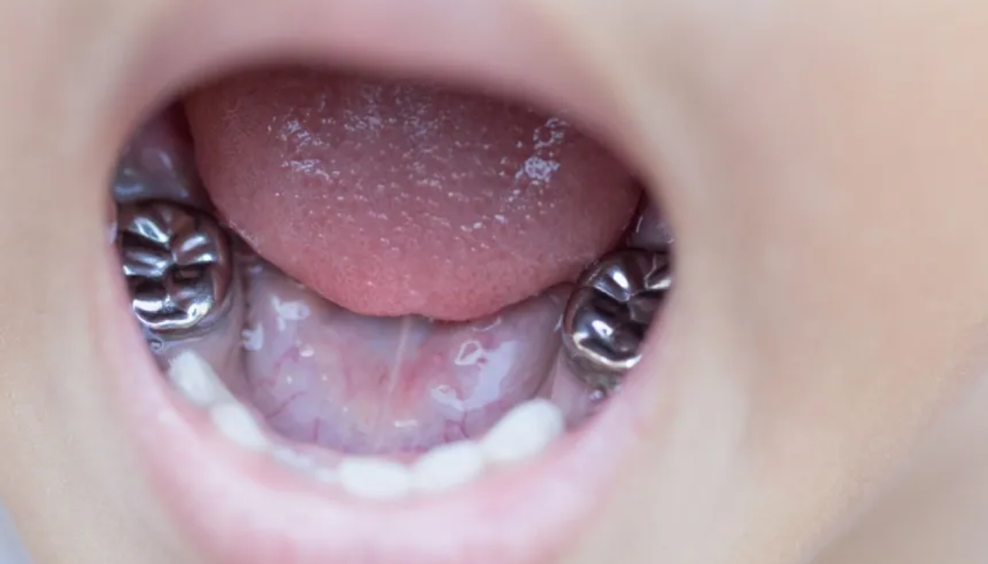 Chụp mão sứ răng sữa cá nhân hóa