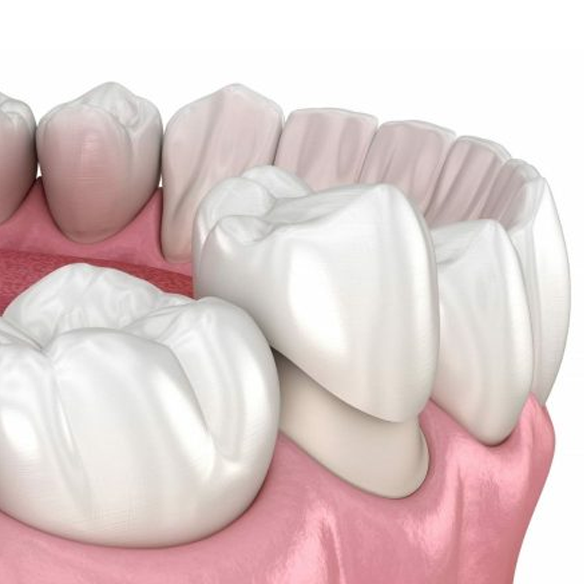Dịch vụ bọc răng sứ Ceramill (Đức)