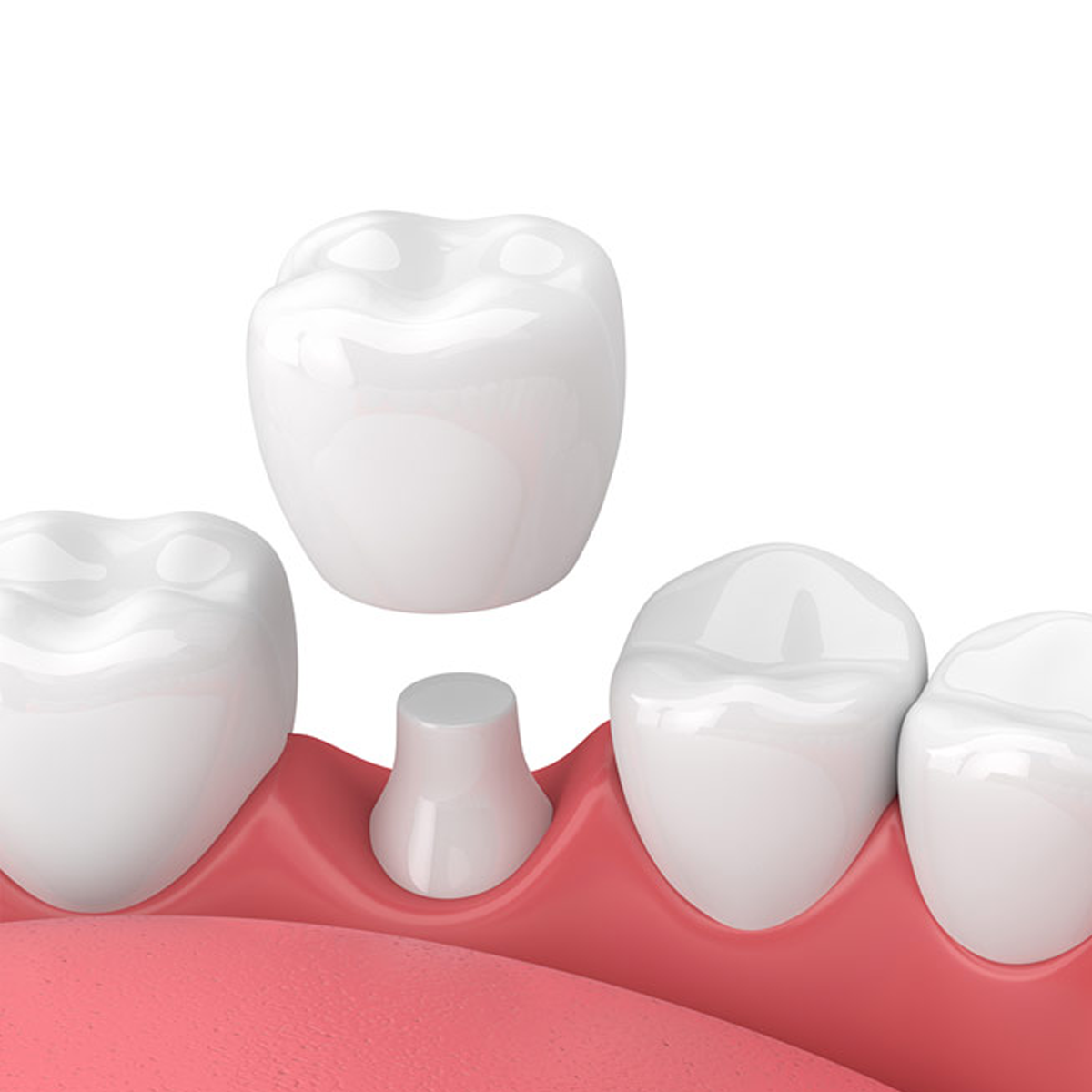 Dịch vụ bọc răng sứ HT Smile (Đức)