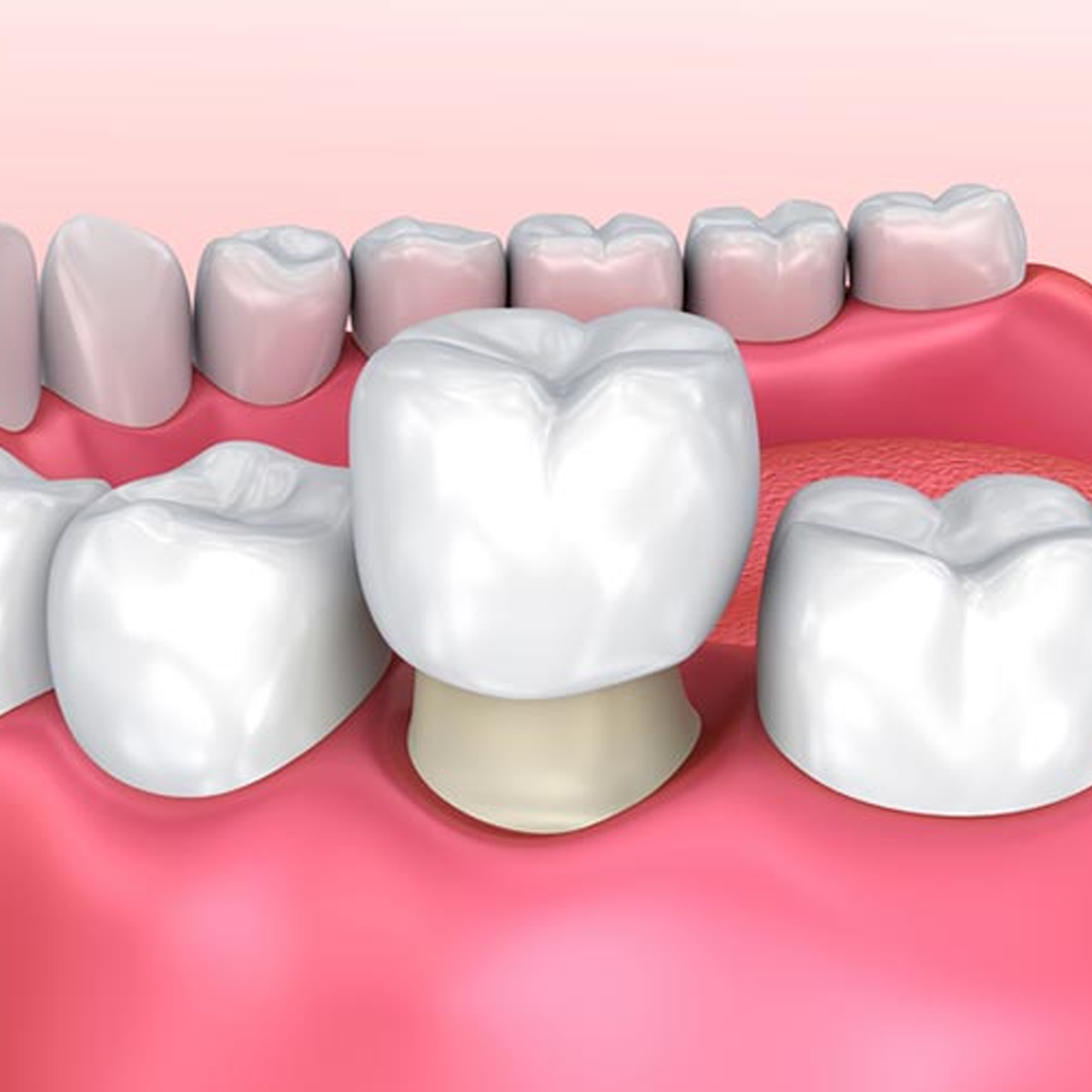 Răng sứ Orodent Multiayer (Italia)