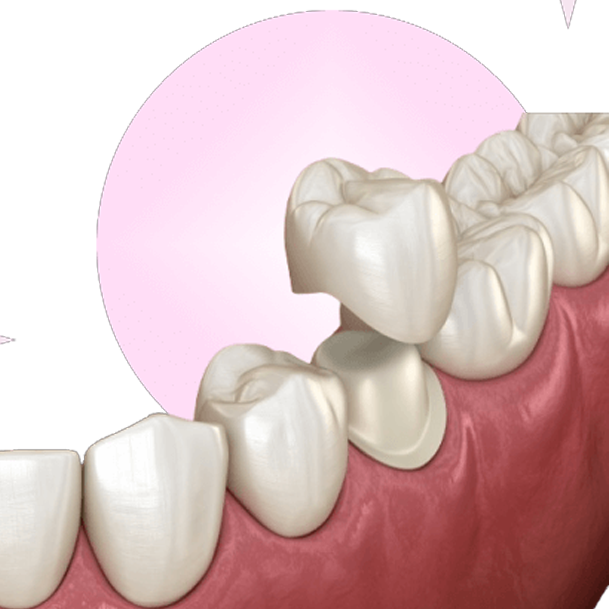 Răng sứ UT Smile (Đức)