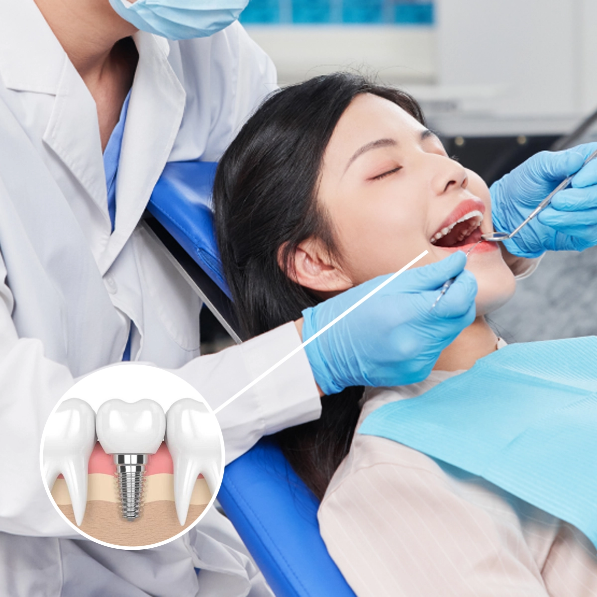 Trồng Răng Implant