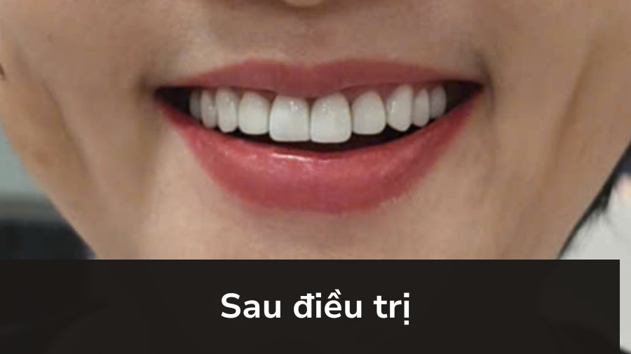 Bùi Thị Thu Hồng (50 tuổi) - Sau điều trị
