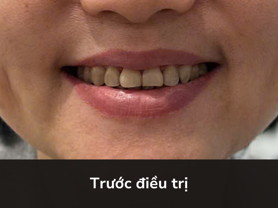 Bùi Thị Thu Hồng (50 tuổi) - Trước điều trị
