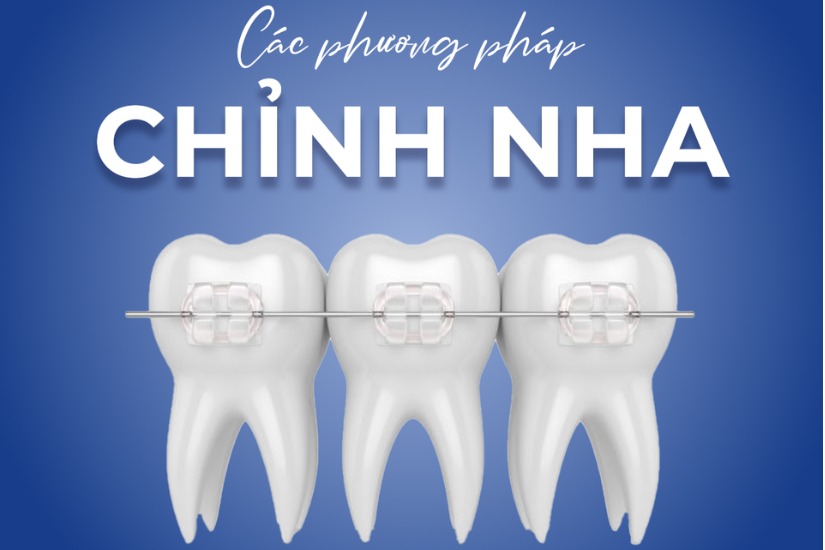 Niềng răng chỉnh nha - Trả góp theo kỳ giá rẻ!